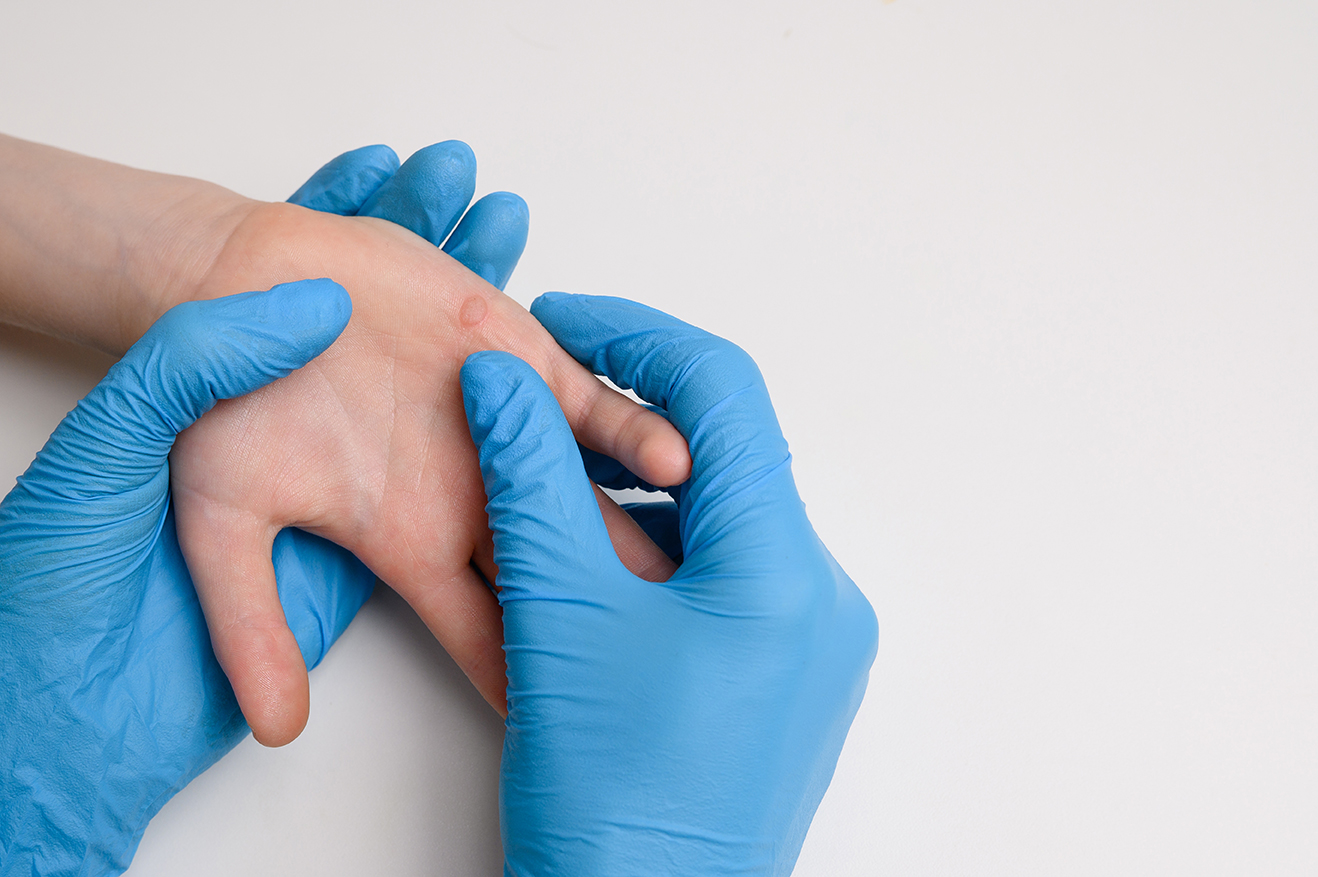 Close-up of a dermatologist examining a wart on a patient’s hand