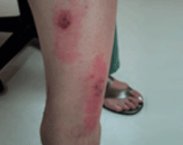 Eczema symptoms – red, inflamed skin