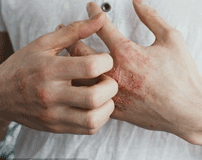 Eczema symptoms – Dry, itchy skin