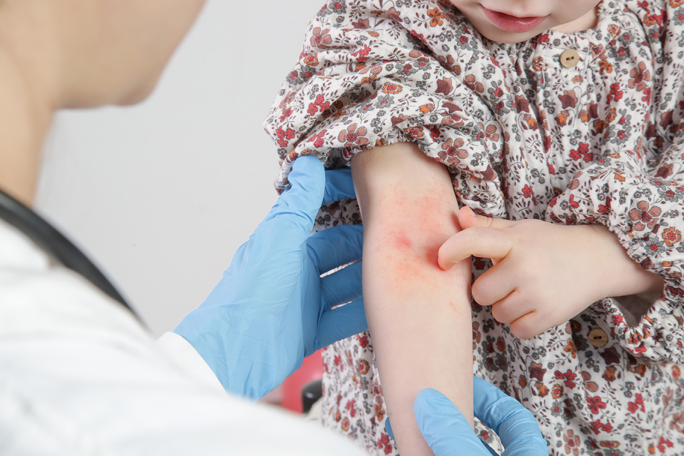 A doctor accessing eczema on a child's arm.