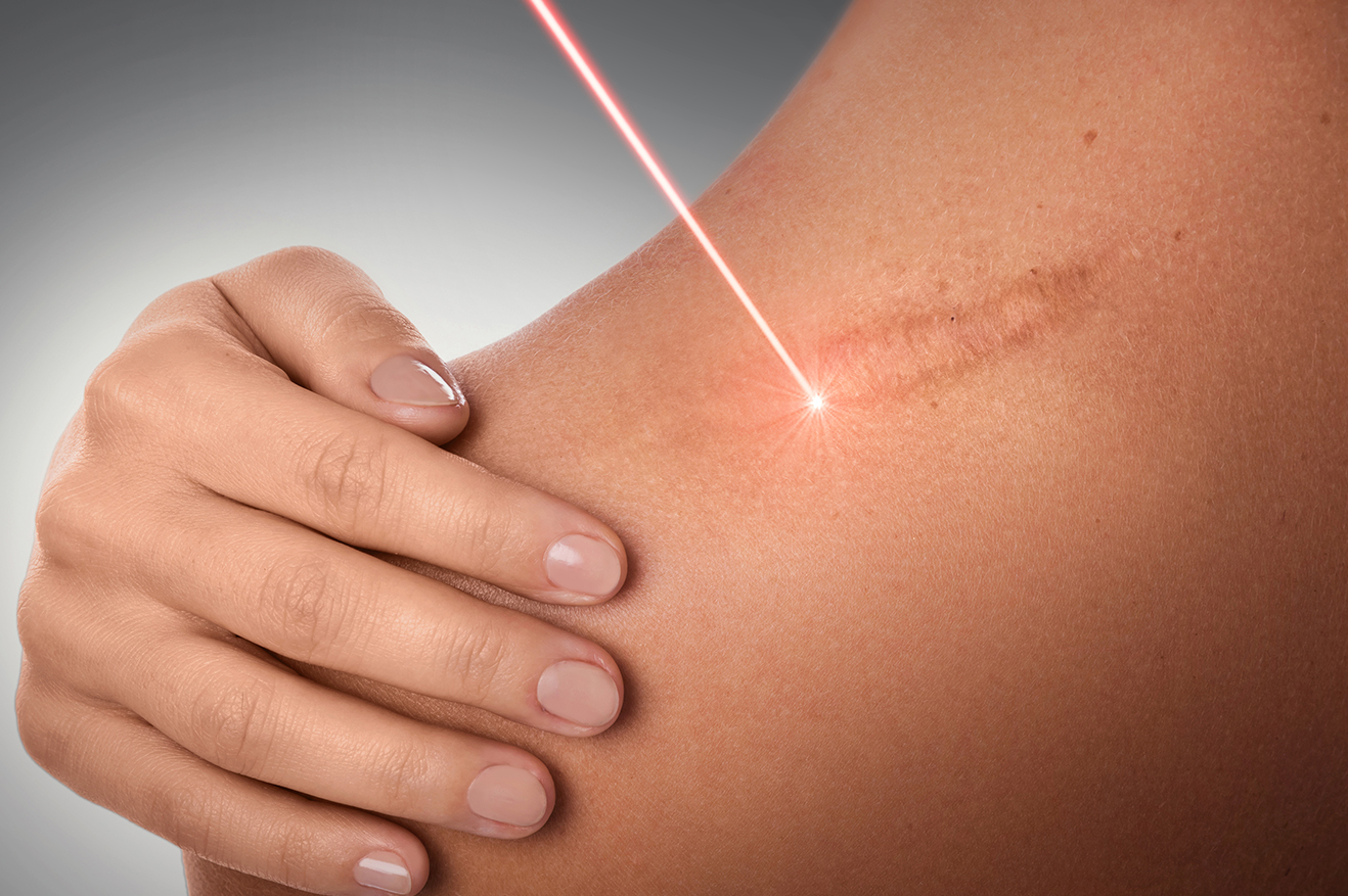 Conceptual image of laser treatment for scar removal